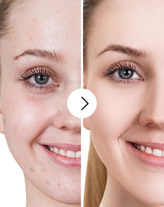 Tabletten voor acne, puistjes en onvolkomenheden met zink, vitamine C, E en B2 van Derminax_5 - 5