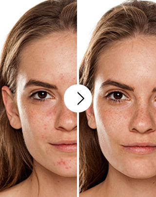 Tabletten voor acne, puistjes en onvolkomenheden met zink, vitamine C, E en B2 van Derminax_2 - 2